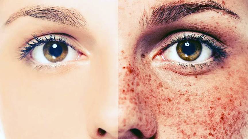 Micro-needling